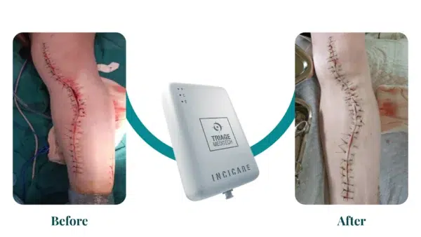 Before and After - Incicare