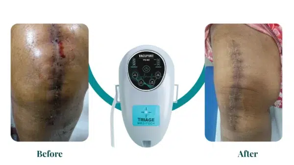 Before and After - Vacuport