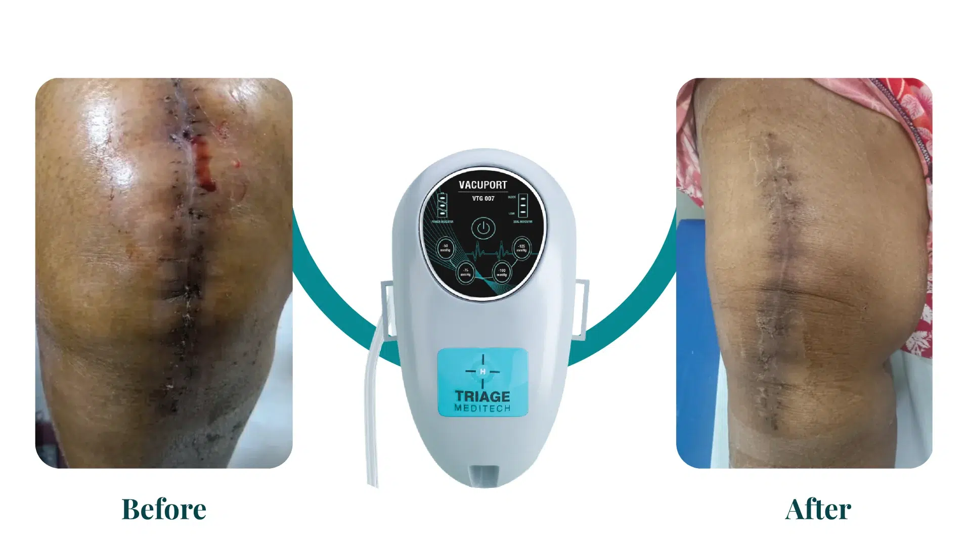 Before and After - Vacuport