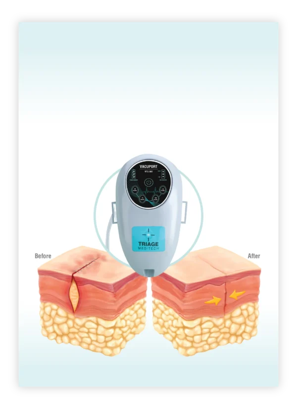 Optimal Dynamic INCISION CLOSURE - Vacuport