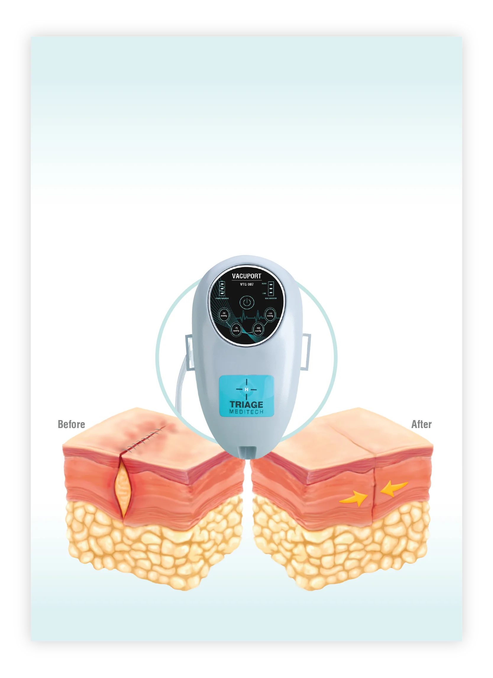 Optimal Dynamic INCISION CLOSURE - Vacuport