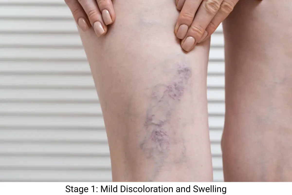 Stage 1 Mild Discoloration and Swelling Stage 1 Mild Discoloration and Swelling of Varicose Veins