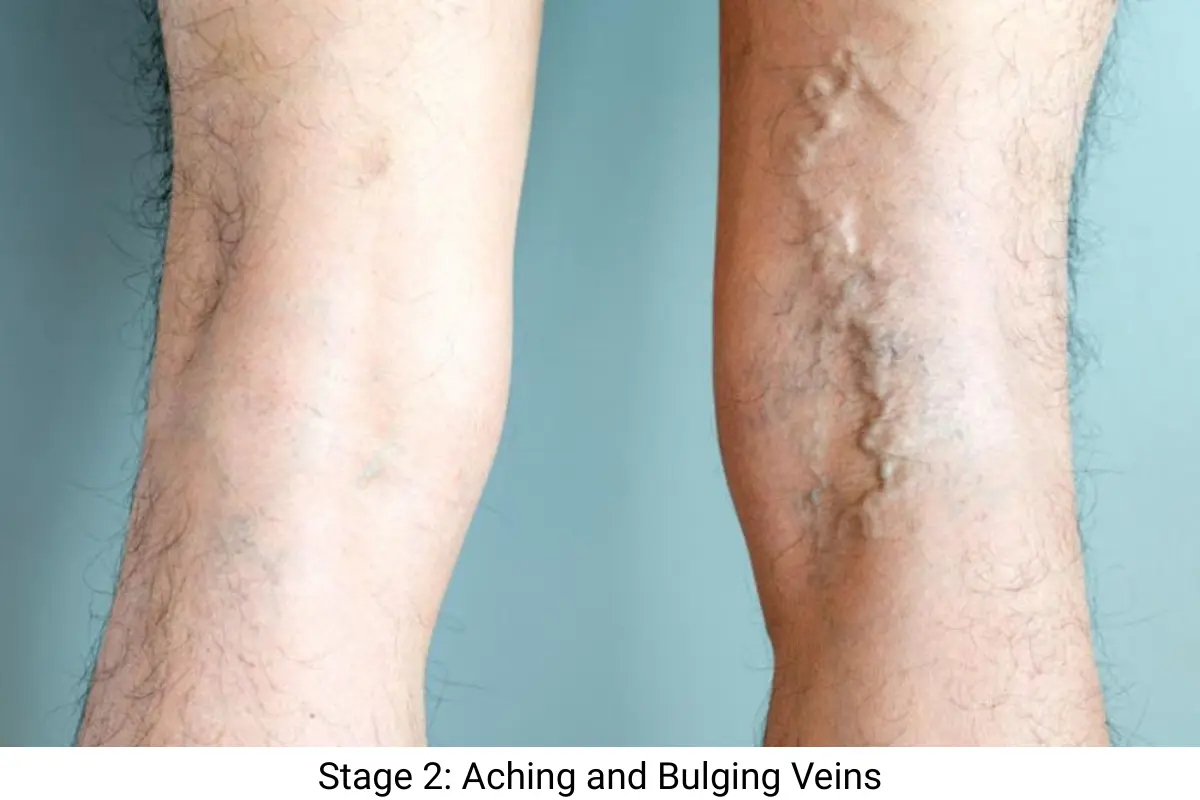 Stage 2 Aching and Bulging Veins Stage 2 of Varicose Veins - Aching and Bulging Veins