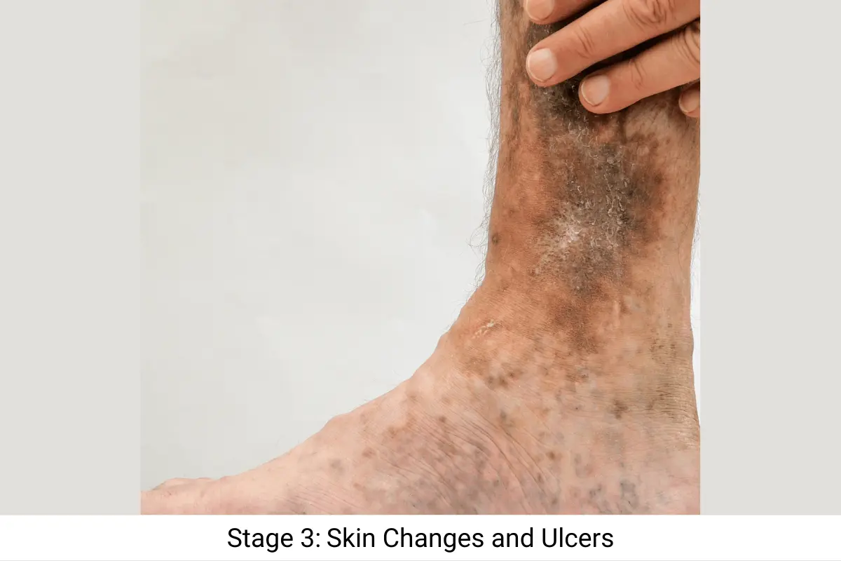 Stage 3 Skin Changes and Ulcers Stage 3 of Varicose Veins - Skin Changes and Ulcers