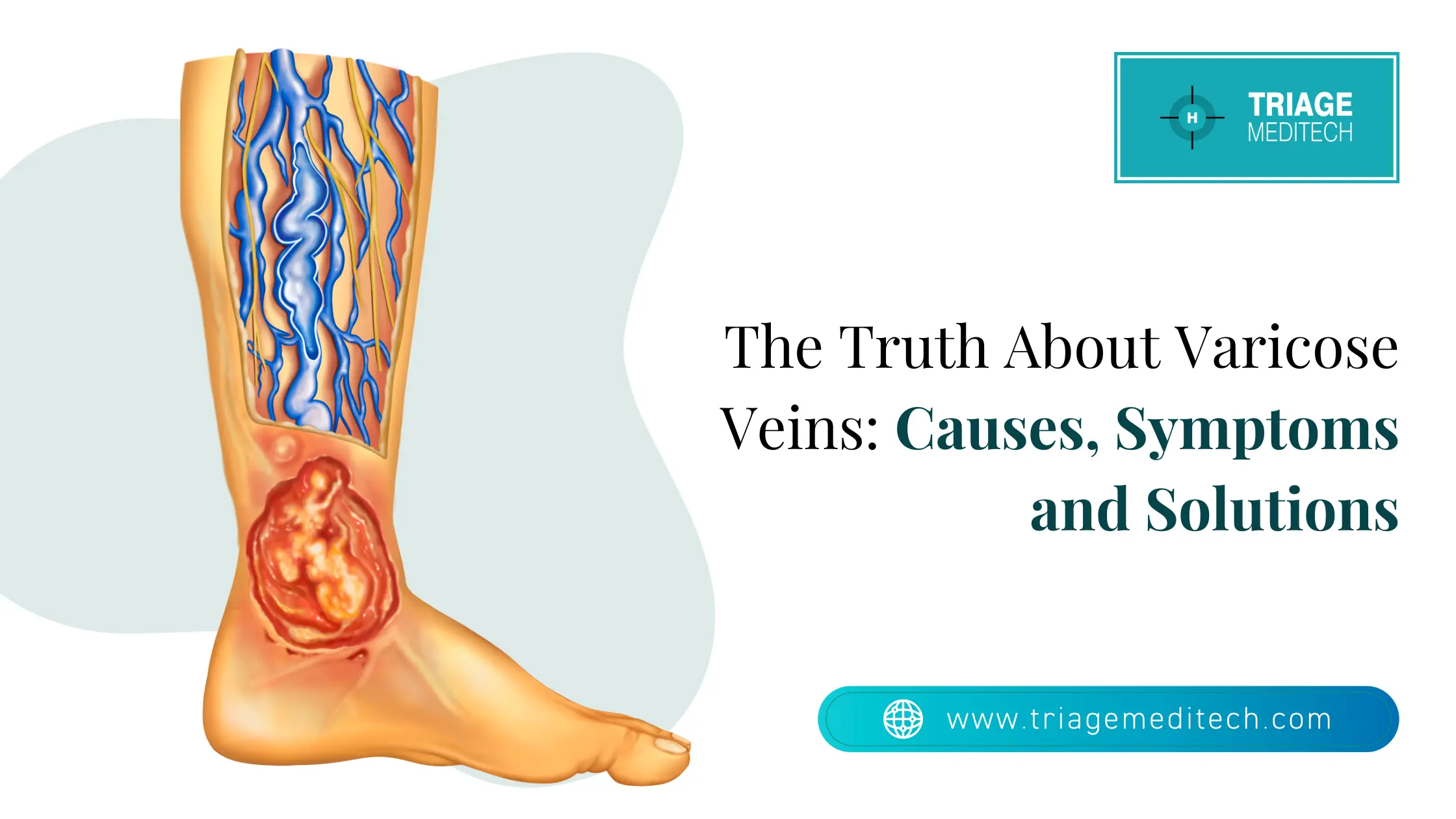 The Truth About Varicose Veins: Causes, Symptoms & Solutions