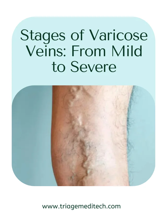 Stages of Varicose Veins: From Mild to Severe