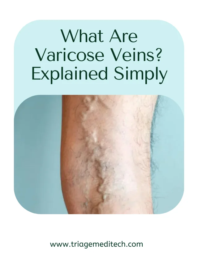 What Are Varicose Veins? Explained Simply