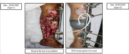 Open Trauma Wound Managed with CCNPWT Therapy Open Trauma Wound Managed with CCNPWT Therapy