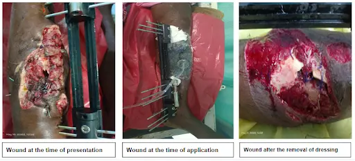 Post Operative Surgical Incision on Knee Using iNPWT Incicare Post-Operative Surgical Incision on Knee Using iNPWT Incicare