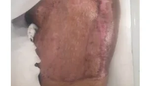 Follow up after 2 months approx - Traumatic Chronic Wound Healing