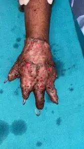 Hand Traumatic Wound after application