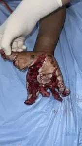 Hand Traumatic Wound before Application