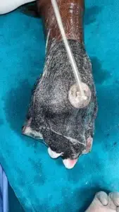 Hand Traumatic Wound during application