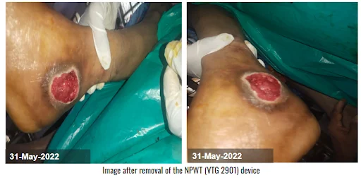 Image after removal of the NPWT VTG 2901 Device Diabetic Foot Ulcer Image after removal of the NPWT (VTG 2901) Device - Diabetic Foot Ulcer