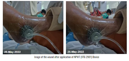 Image of the wound after application of NPWT VTG 2901 Device Diabetic Foot Ulcer Image of the wound after application of NPWT (VTG 2901) Device - Diabetic Foot Ulcer
