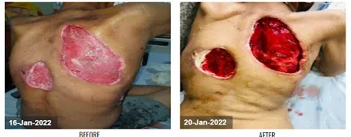 PRESSURE ULCER USING CCNPWT VTG 2901