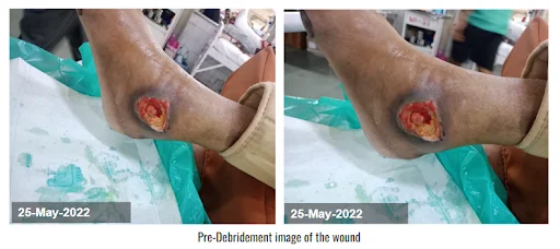 Pre Debridement Image of the wound Diabetic Foot Ulcer Pre-Debridement Image of the wound - Diabetic Foot Ulcer