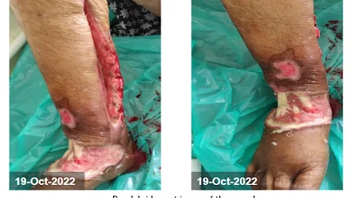 Pre-Debridement Image of the wound - Diabetic Leg Ulcer