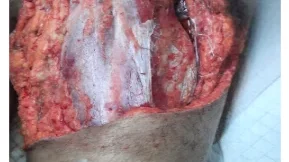 Pre-Debridement Image of the wound - Traumatic Chronic Wound Healing