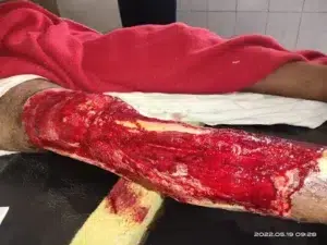 Traumatic Wound after application Traumatic Wound after application