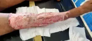 Traumatic Wound before Application