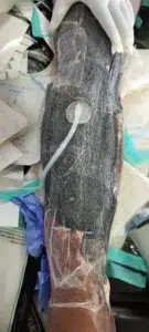 Traumatic Wound during application