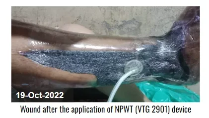 Wound after application of NPWT (VTG 2901) Device - Diabetic Leg Ulcer