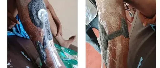 Wound after application of NPWT (VTG 2901) Device - Venous Leg Ulcer