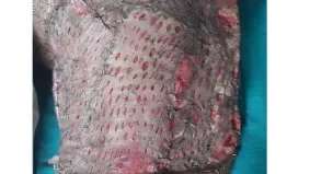 Wound after application of skin-grafting - Traumatic Chronic Wound Healing