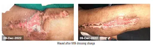 Wound after fifth NPWT dressing change ( 09 Dec 2022)