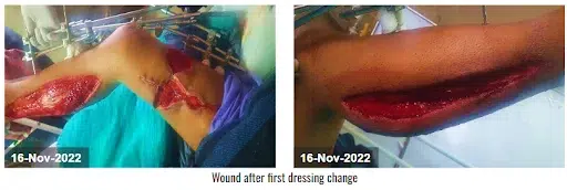 Wound after first NPWT dressing change (16 nov 2022)