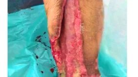 Wound after first dressing - Diabetic Leg Ulcer