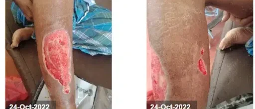 Wound after first dressing change - Venous Leg Ulcer