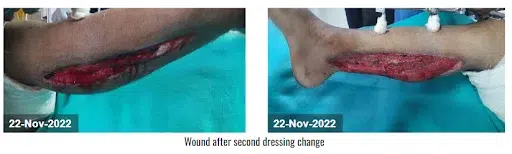 Wound after second NPWT dressing change (22 nov 2022)
