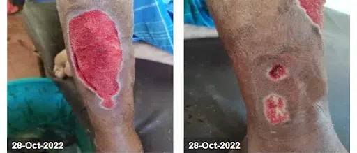 Wound after second dressing change - Venous Leg Ulcer