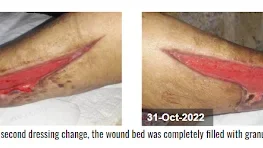 Wound after second dressing change, the wound bed was completely hiled with granulation tissue