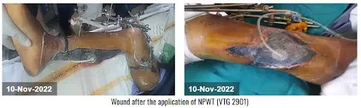 Wound after the application of NPWT (VTG 2901) - 10 Nov