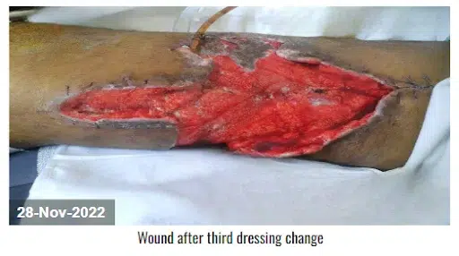 Wound after third NPWT dressing change ( 28 Nov 2022)