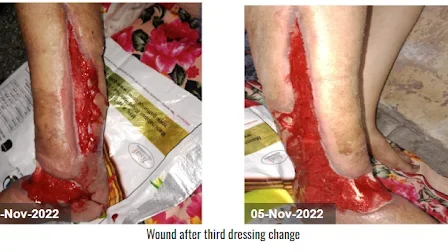 Wound after third NPWT dressing change - Diabetic Leg Ulcer