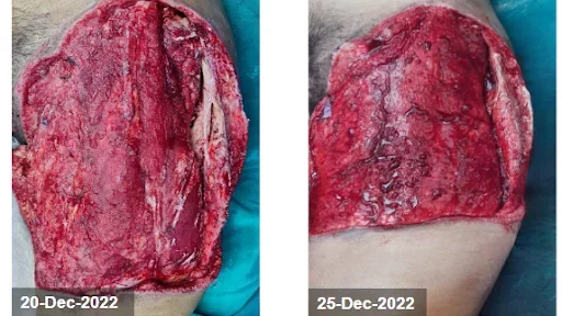 Wound after third and fourth dressing change - Traumatic Chronic Wound Healing