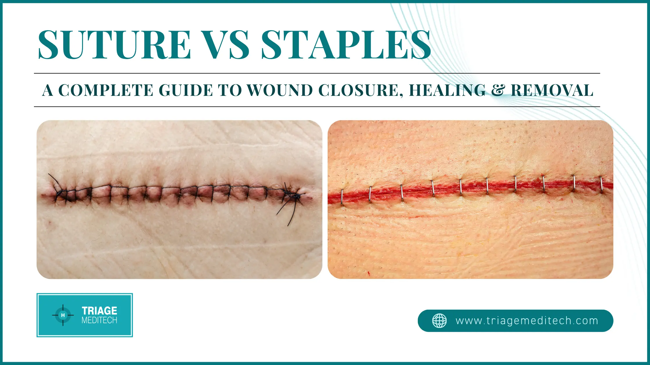 Suture vs Staples - Triage Meditech