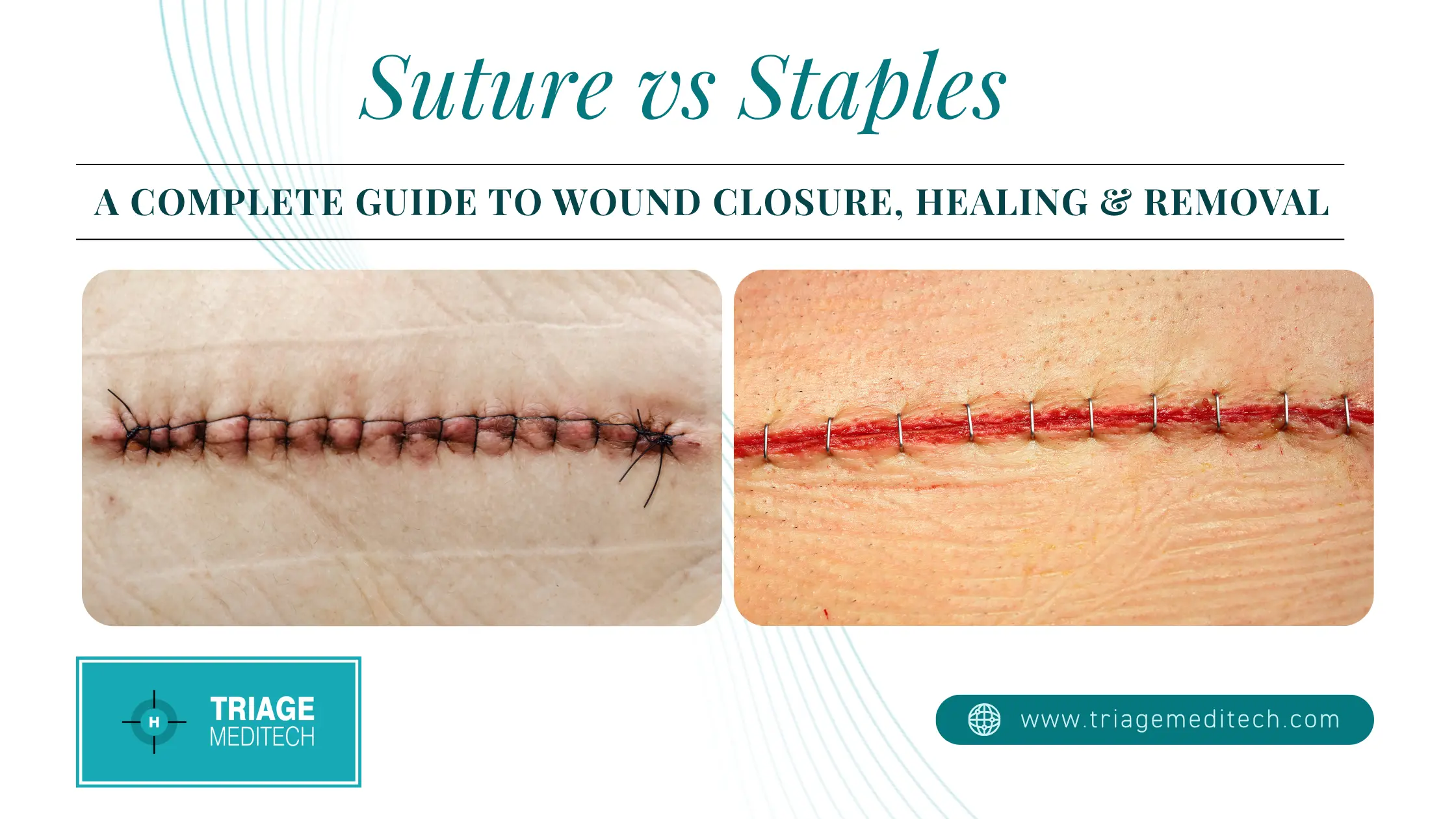 Suture vs Staples