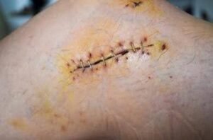 What Are Staples - Sutures vs Staples
