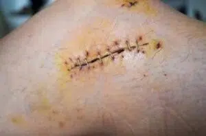 What Are Staples Sutures vs Staples What Are Staples - Sutures vs Staples