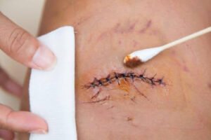 What Are Sutures - Sutures vs Staples