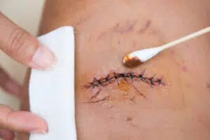 What Are Sutures Sutures vs Staples What Are Sutures - Sutures vs Staples