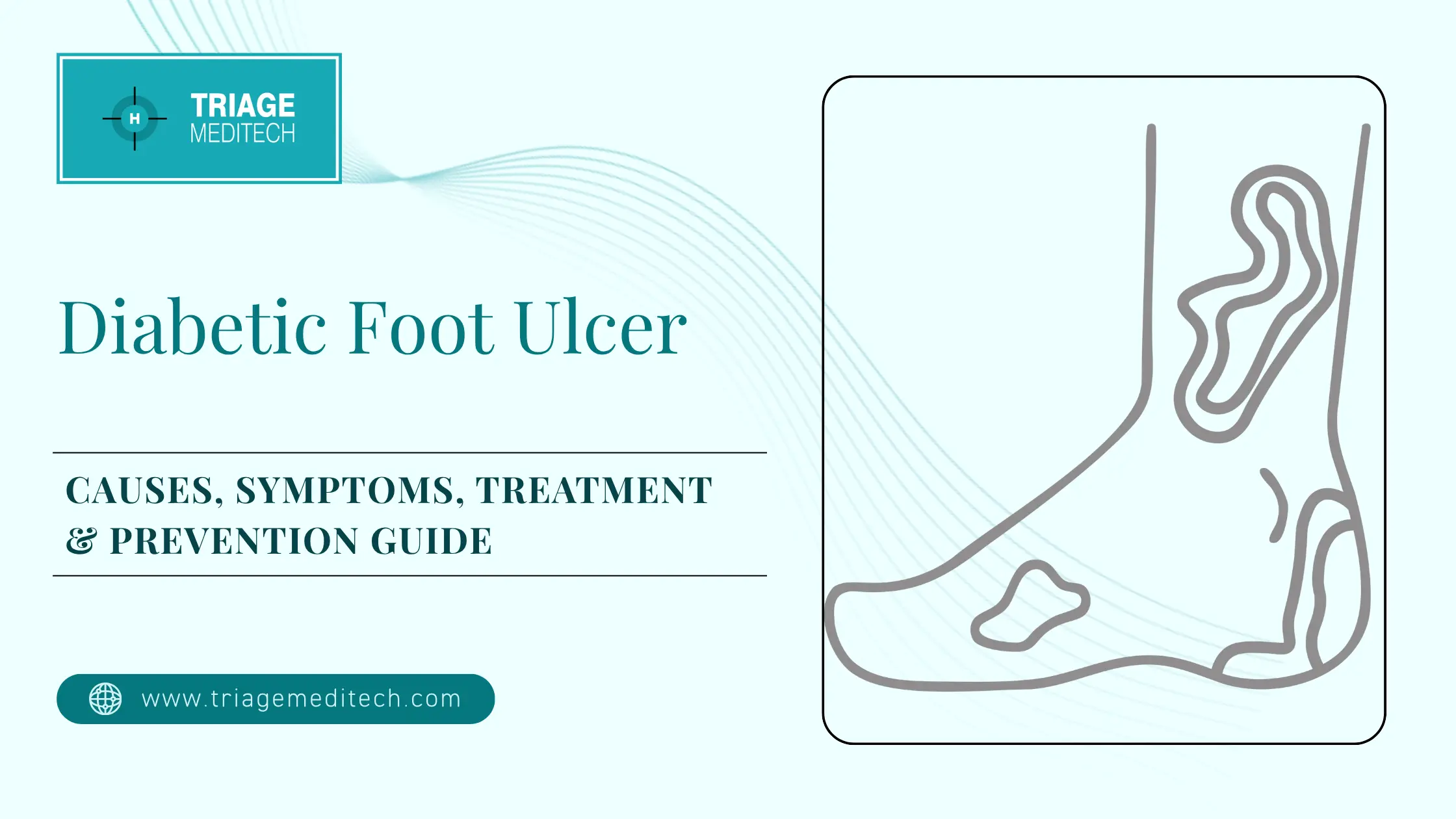 Diabetic Foot Ulcer Guide Diabetic Foot Ulcer Guide