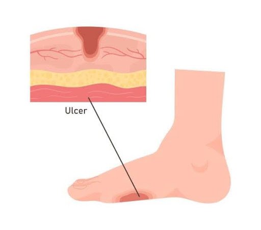 Foot Deformities and Pressure Points