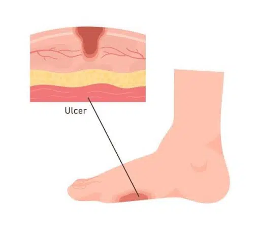 Foot Deformities and Pressure Points