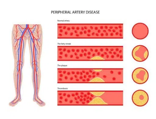 Peripheral Arterial Disease (PAD) - Poor Circulation